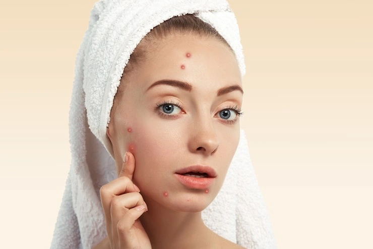Figuring Out Fungal Acne on Your Forehead